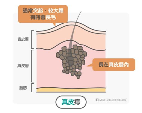 男生點痣|點痣筆一擦，黑痣就掉了？醫師冷笑科科兩聲：「點痣。